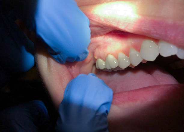 Best Tooth Infection Emergency Dentist  in St Francis, KS